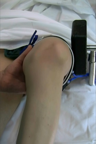 Lussazione laterale di rotula con la flessione del ginocchio.